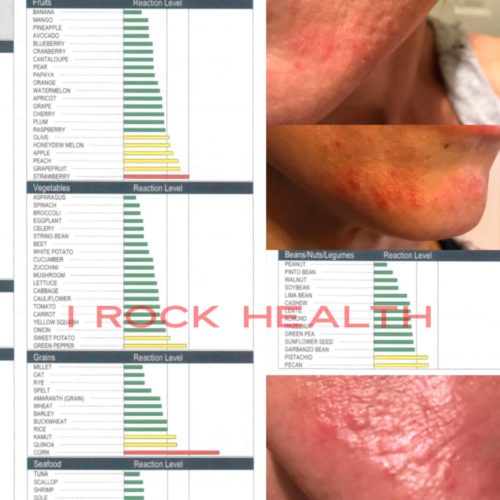 LEAP Food Sensitivities Test Picture of Face During A Flare