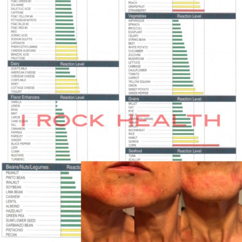 LEAP Food Sensitivities Test - 2nd Picture Of My Face And A Copy Of The Test
